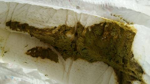 我家宝宝两个月五天,化验大便白细胞两个加,隐