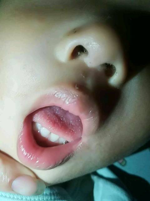 宝宝得了杨梅舌怎么办啊?