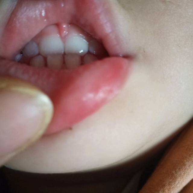 宝宝牙齿是下牙包上牙?