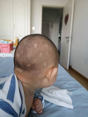 孩子头皮癣状脱发,一块一块的,社区医生说是真菌感染
