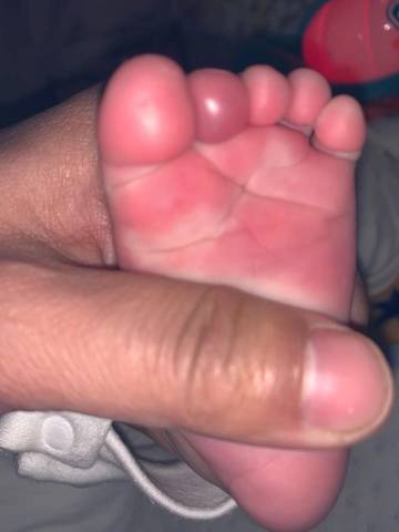 宝宝脚趾肿了!
