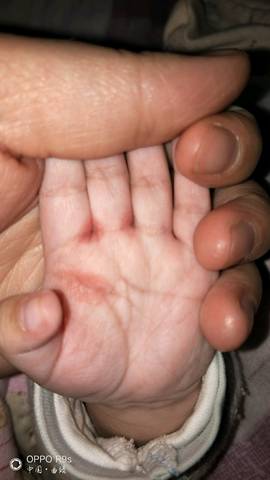 2个多月宝宝手掌红是不是湿疹,麻烦大家帮忙看一下