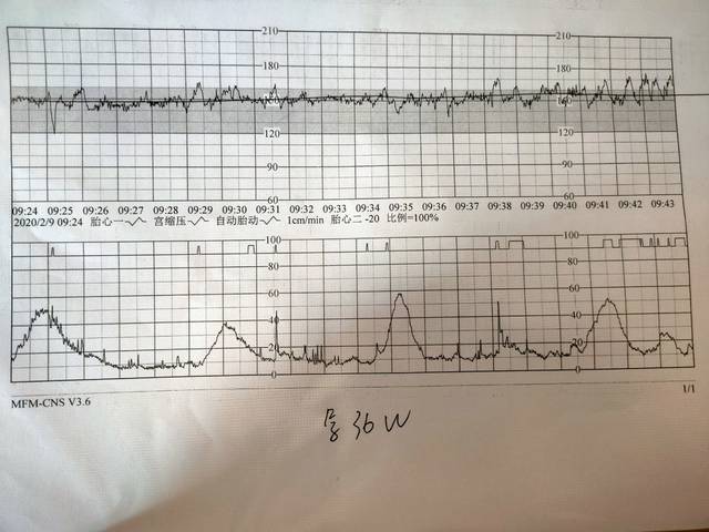 胎心监护!有没有看得懂的?_第一张医生说不合格,重新