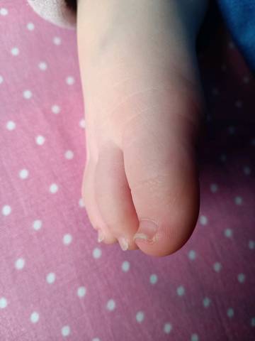 宝宝快两岁了,脚大拇指指甲外翻,比较厚,怎么回事,是缺什么了吗?