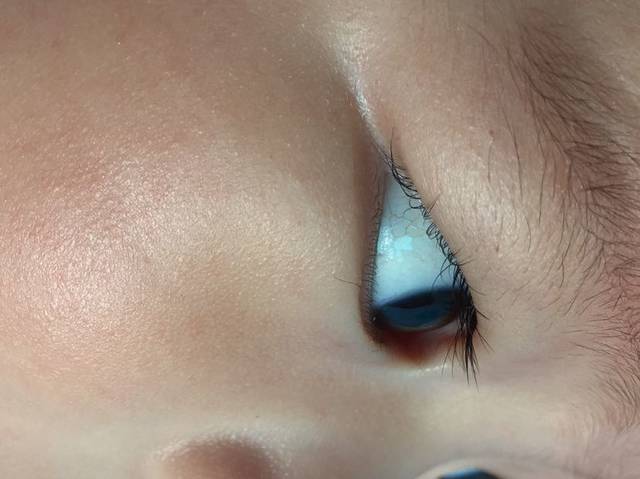 宝宝的眼睛有红血丝