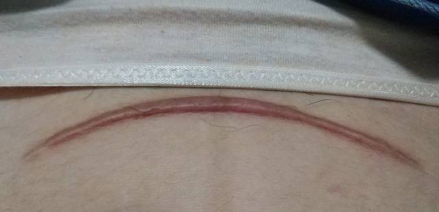 剖腹产的宝妈,你们的刀疤怎么样了?