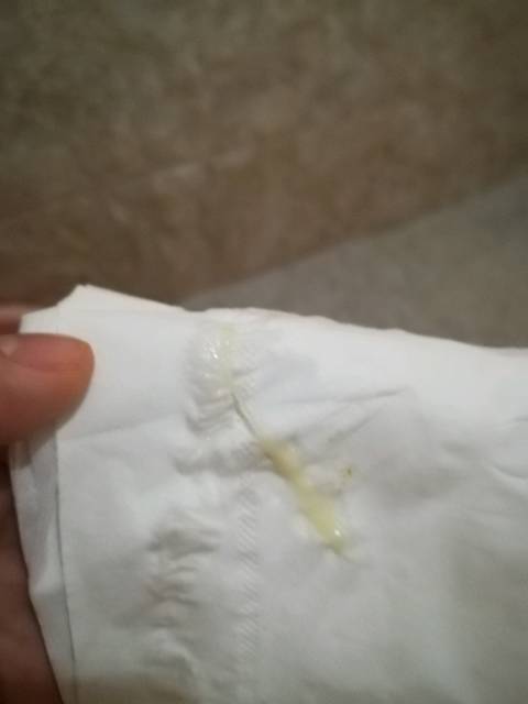 孕38周一直稳稳的 今早发现这个 有图慎入