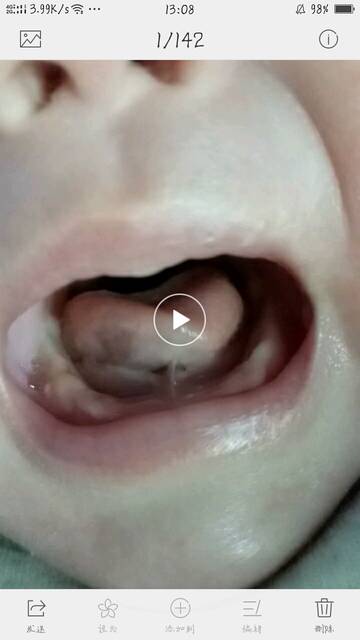 大家好_宝宝哭的时候发现舌头下面两个洞是不是舌系带