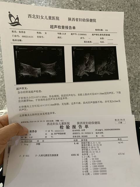 怀孕40突然有点出血,考虑宫外孕