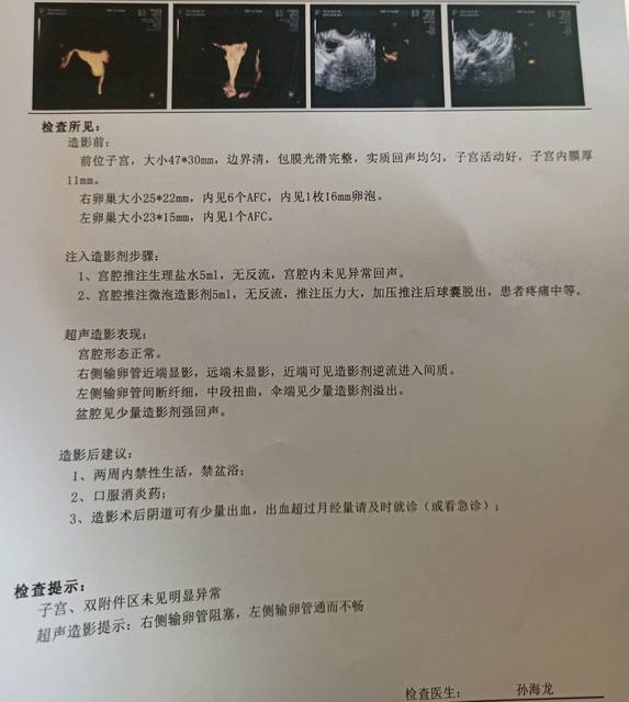 求助输卵管堵塞,另侧通而不畅