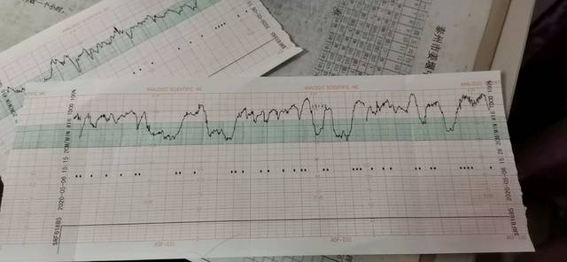 34 4胎心监测 一直说胎动频繁