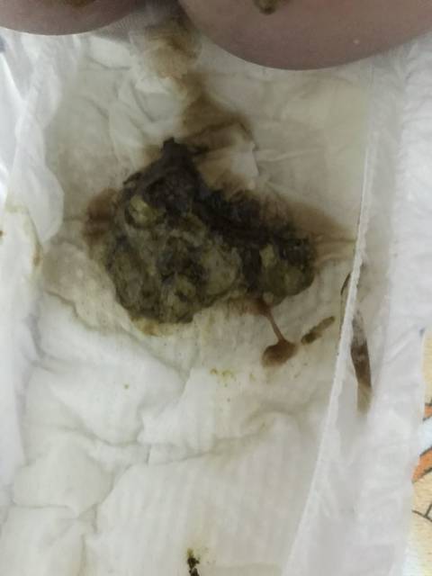 轮状病毒性腹泻_我家崽崽28号拉肚,拉的很稀,大便去时