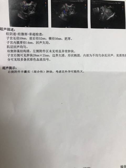 怀孕七八周左右,今天彩超检查出是宫外孕