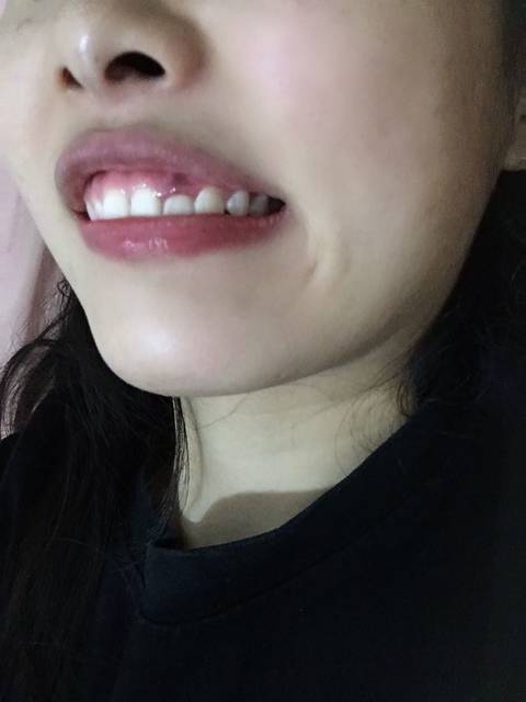 移植_yz:第三天,一觉醒来刷牙发现牙龈肿了发紫 百度