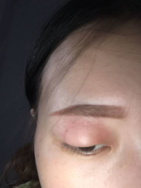 眼睛肿了