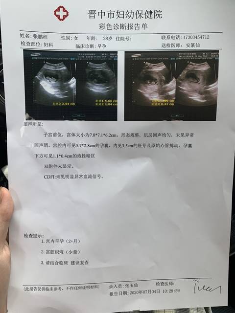 10周的孕囊