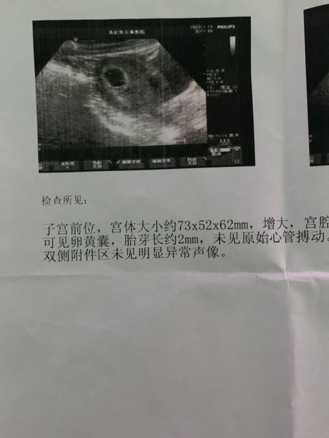 仔细看孕囊里有两个胎_这是双胞胎?_宝宝树