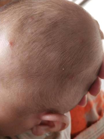 三个多月孩子头上长痘有问题没