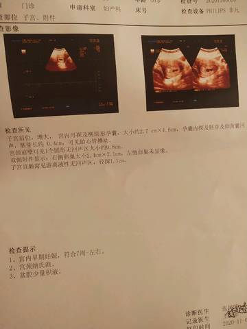 怀孕七周看孕囊可以知道是生男生女么?孕囊椭圆形大小