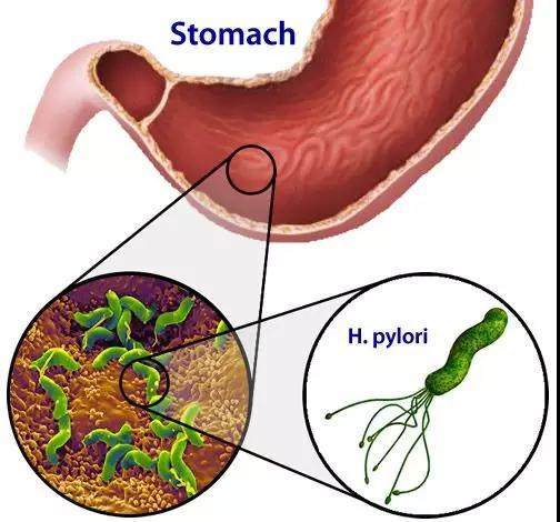 原来幽门螺旋菌感染率这么高,平时带宝宝一定
