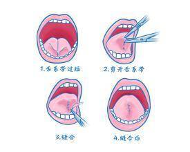 孩说话大舌头、讲话不清楚,真的要割舌系带吗