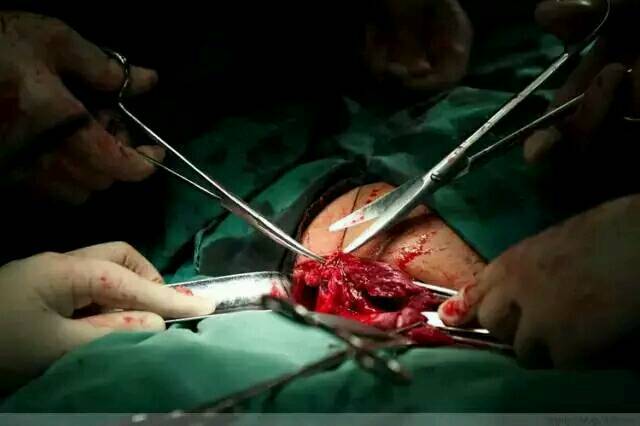 100张照片,100%还原"剖腹产"全过程!(有图慎入)