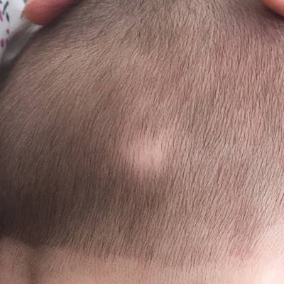 宝宝80天,五天前发现后脑有一白色头发也掉啦,现在感觉在扩散!
