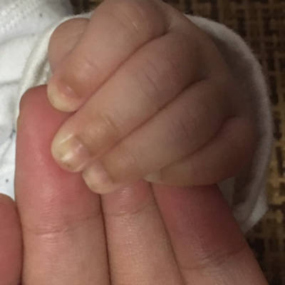 婴儿十个手指前端发黑图片