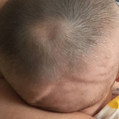 宝宝缺钙后脑勺图片图片