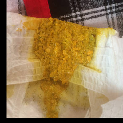 专家您好,我家宝宝今天第25天,纯母乳餵养,睡觉时经常拳打脚踢,脸憋的