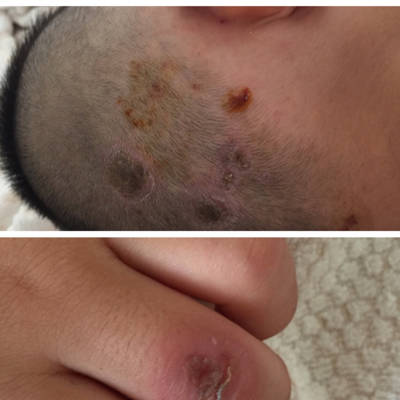 破了之后大面积像是溃烂似的,身上以多处有了,面积蔓延的挺大孩子总抓