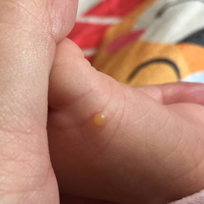 快两个月,脚上长了个水泡,有认识的吗?_宝宝树