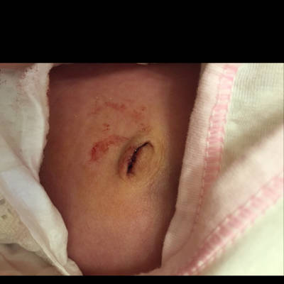 我家宝宝出生第17天了,今天肚脐眼掉了,可是我看到有稍稍的血流出