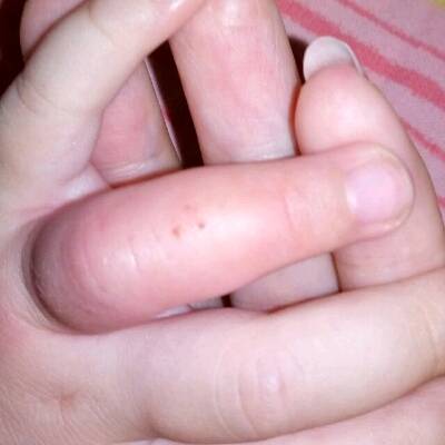 宝宝手指头红肿怎么回事?是不是被虫子咬了?