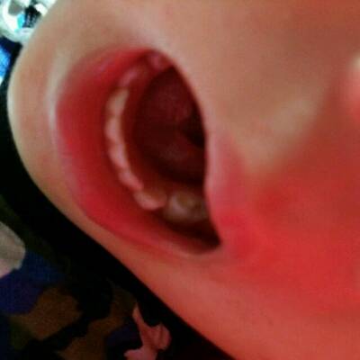 宝宝舌头下长泡的图片图片