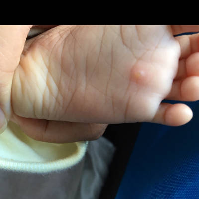宝宝脚底湿疹图片