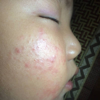 宝宝的脸上是不是对什黱东西过敏了还是怎黱搞得那