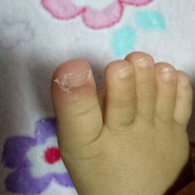 宝宝脚趾头红肿图片图片