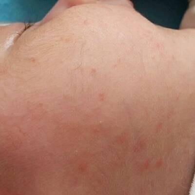 09-19 推荐回答                     我宝宝也是这样 医生说是热毒