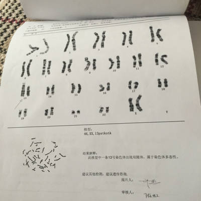 染色体报告这样的,说13号染色体双随体,准备试管婴儿,不知道有影响吗?