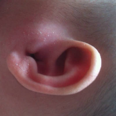 孩子3个月,一天前耳屏处起一疙瘩,摸起来硬,略高於皮肤,今天耳道都肿