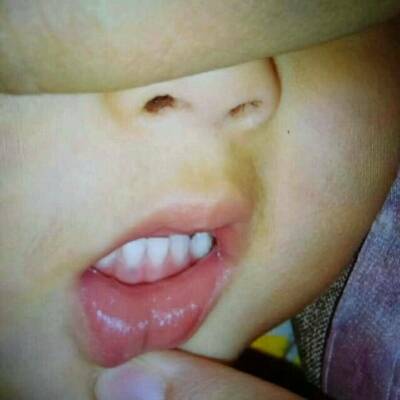 小孩牙龈发黑发紫图片图片