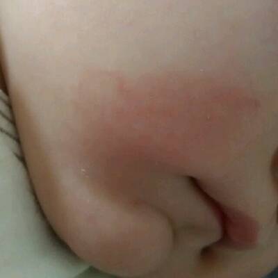 宝宝转奶过敏红疹图片图片