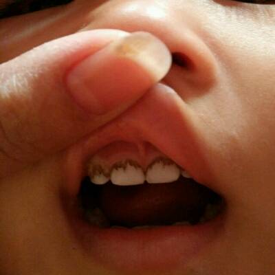 宝宝牙齿长斑图片图片