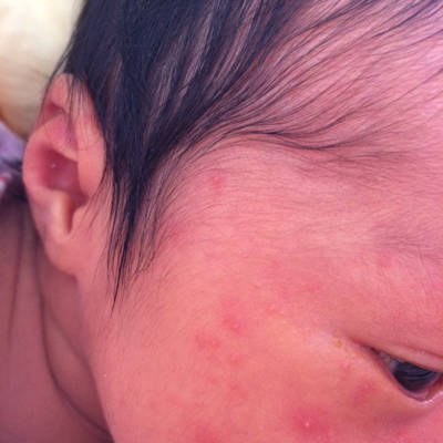 湿疹图片婴儿初期图片