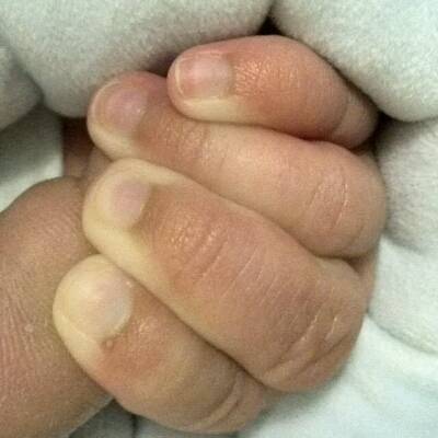 宝宝四十天了,今天发现他的手指甲下方的皮肤变黑了请问是什麼问题?