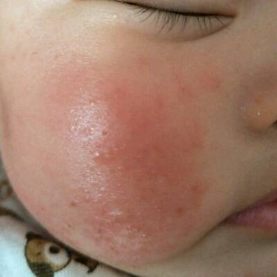 新生儿湿疹和痤疮图片图片