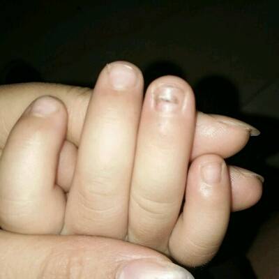 一岁八个月宝宝指甲起壳,裏面又长出了新的指甲,这是怎麼回事儿啊?
