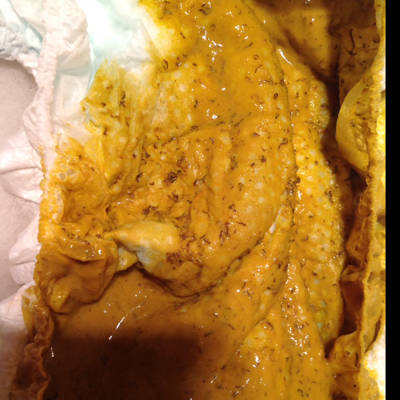 宝宝大便里有这种东西怎么回事?已经添加辅食