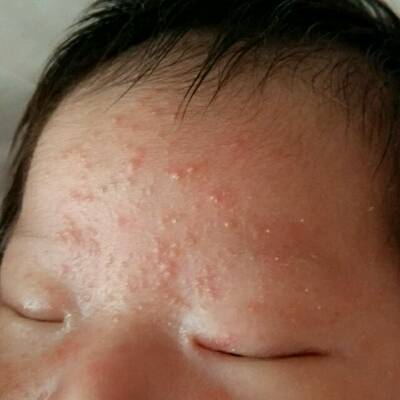 新生儿痤疮怎么引起的图片